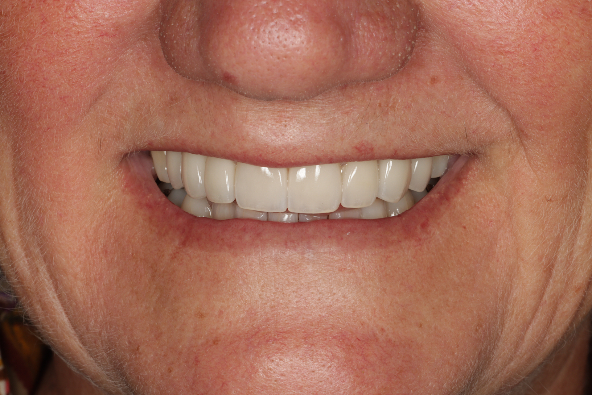 After porcelain crowns and composite restorations