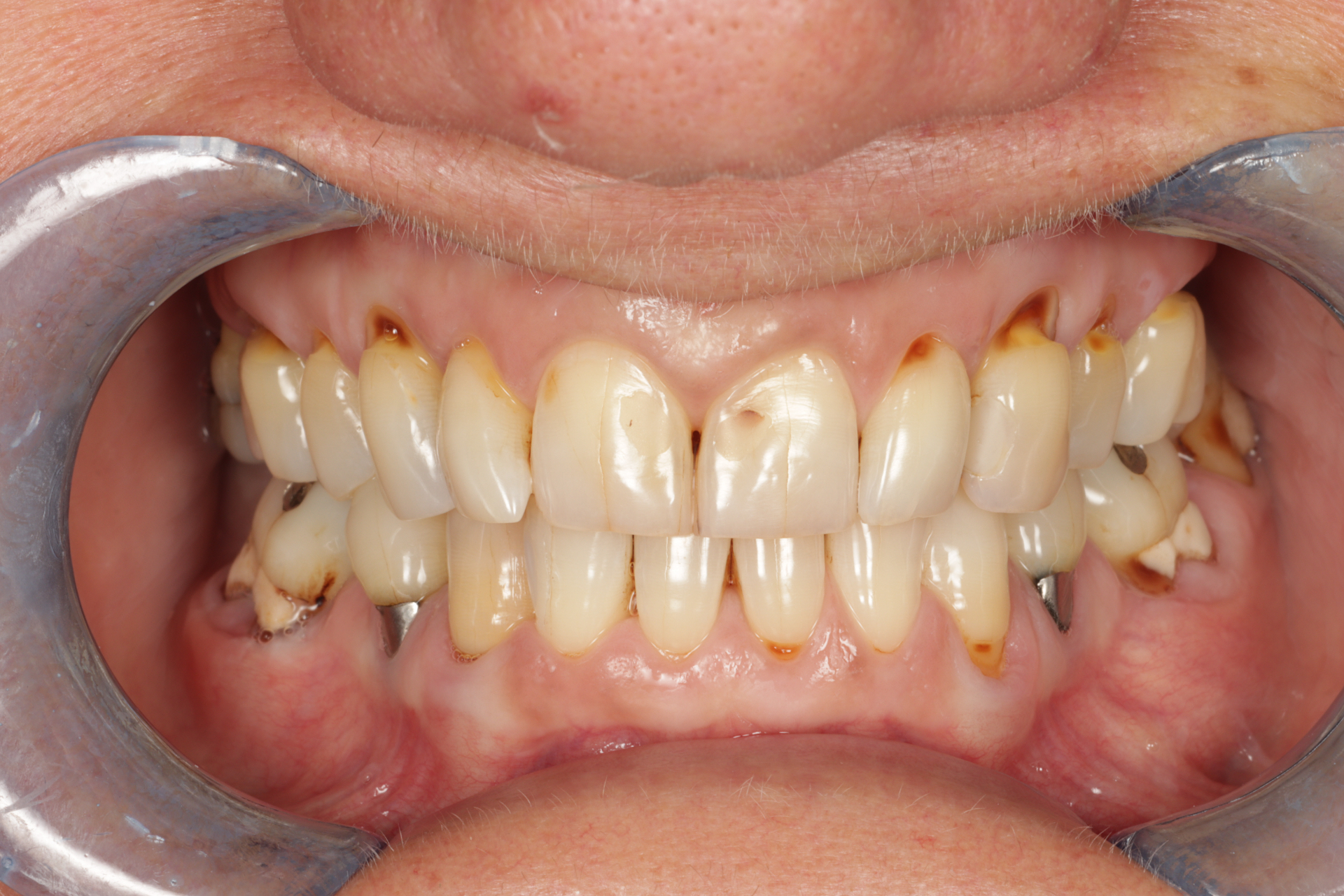 Before composite restorations