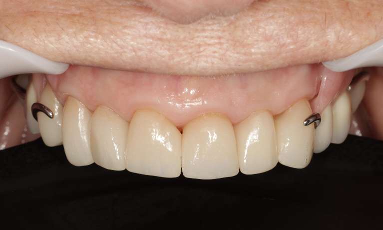 After crowns and partial - complete restoration