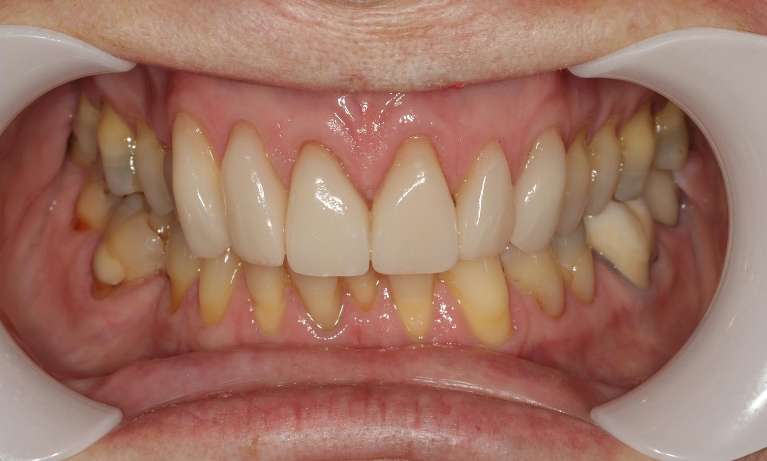 After porcelain veneers - transformed smile