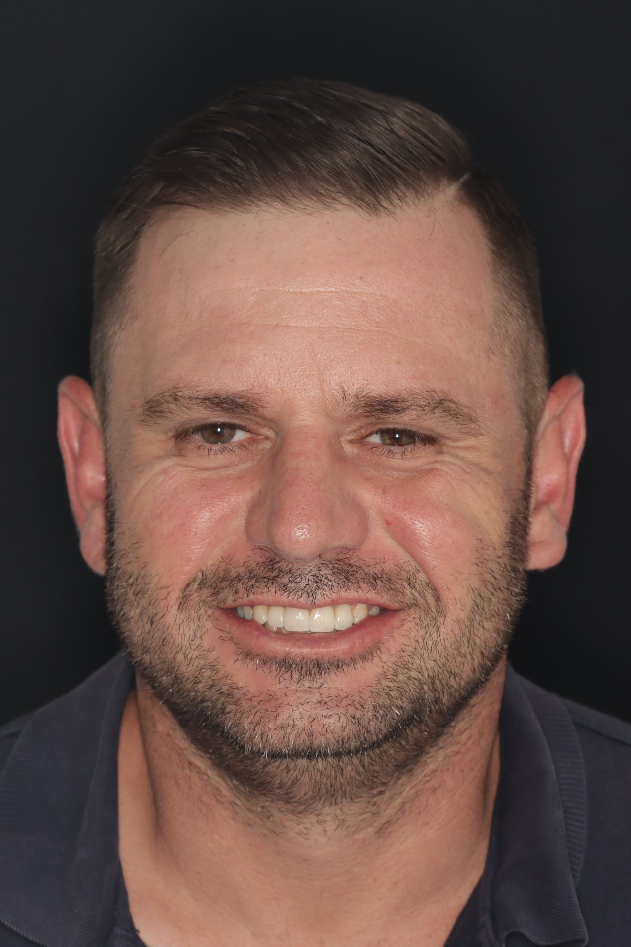 After porcelain crowns and composite restorations