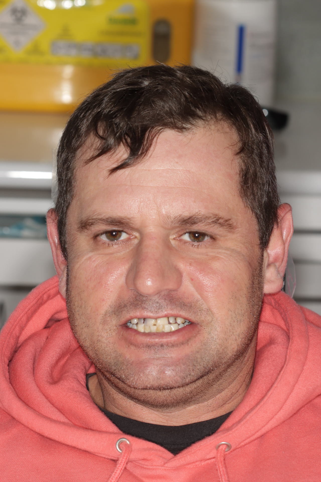 Before composite restorations