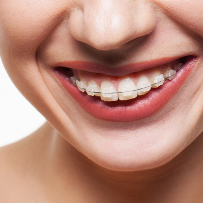 Is Invisalign® Right for Me?